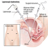 Hysterectomy Laparoscopic Abdominal Vaginal NDVH